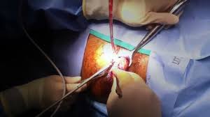 Laser Hemorrhoidectomy